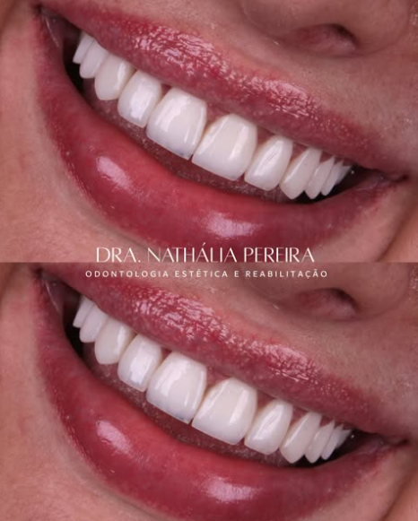 Caso 05 — Lentes em Resina